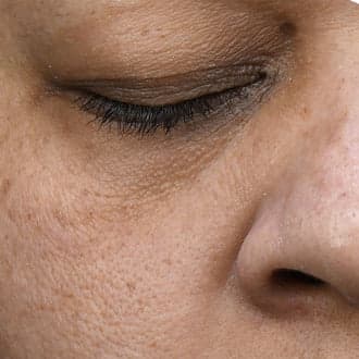 Fine lines — before