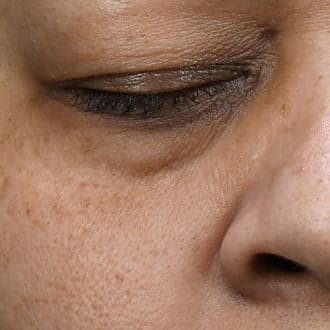 Fine lines — after